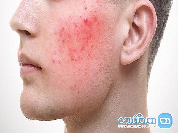 بیماری پوستی که در مردان شدیدتر است